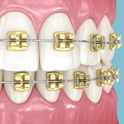 Gold Colored Braces